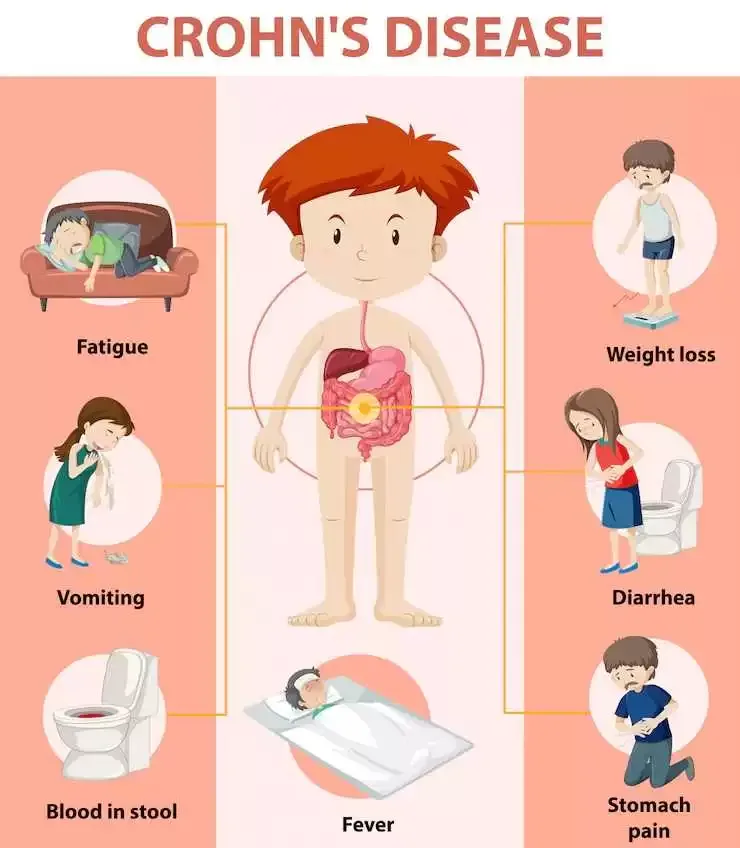 2. Boala Crohn simptome - Care sunt cele mai frecvente simptome ale bolii Crohn_Exemple de simptome in boala Crohn